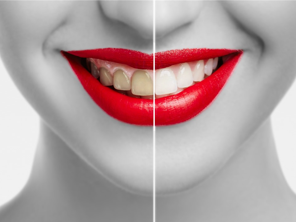 הלבנת שיניים