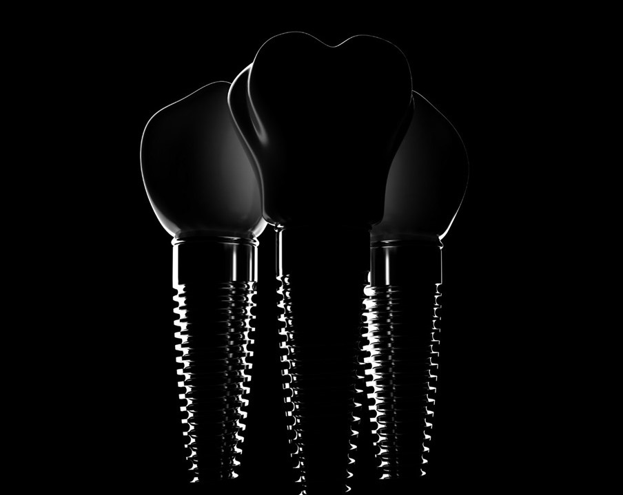 השתלות שיניים